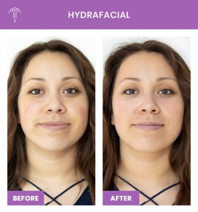 HydraFacial – 3 FOY NYC