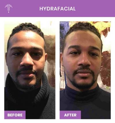 HydraFacial – 1 FOY NYC