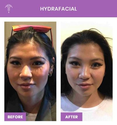 HydraFacial – 2 FOY NYC