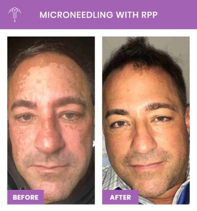 Microneedling with RPP – 1 FOY NYC