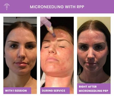 Microneedling with RPP – 2 FOY NYC